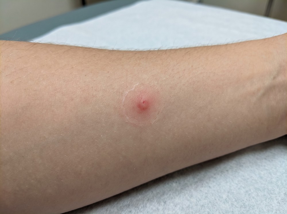 Close-up photo of a fresh broad-faced sac spider bite showing a small red swollen welt with mild surrounding erythema on skin